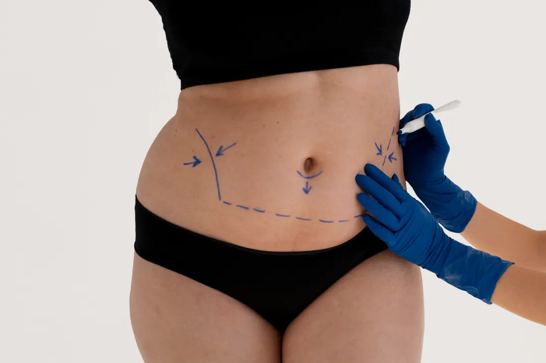 Abdominoplastia