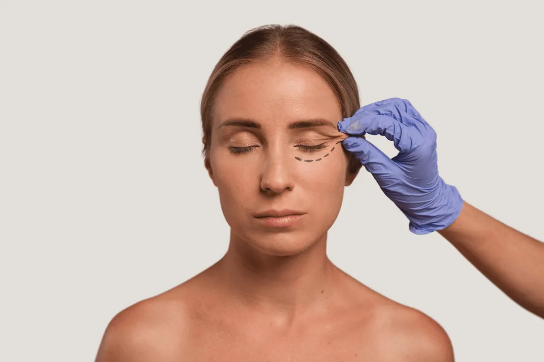 Blefaroplastia