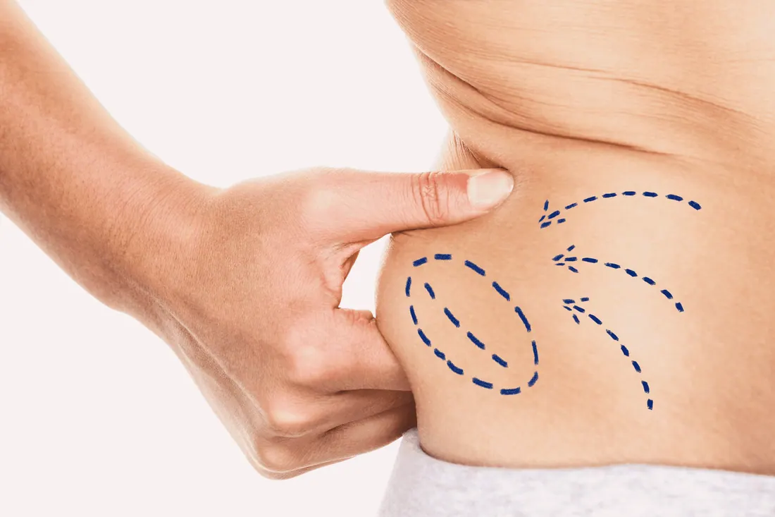 Lipoaspiração