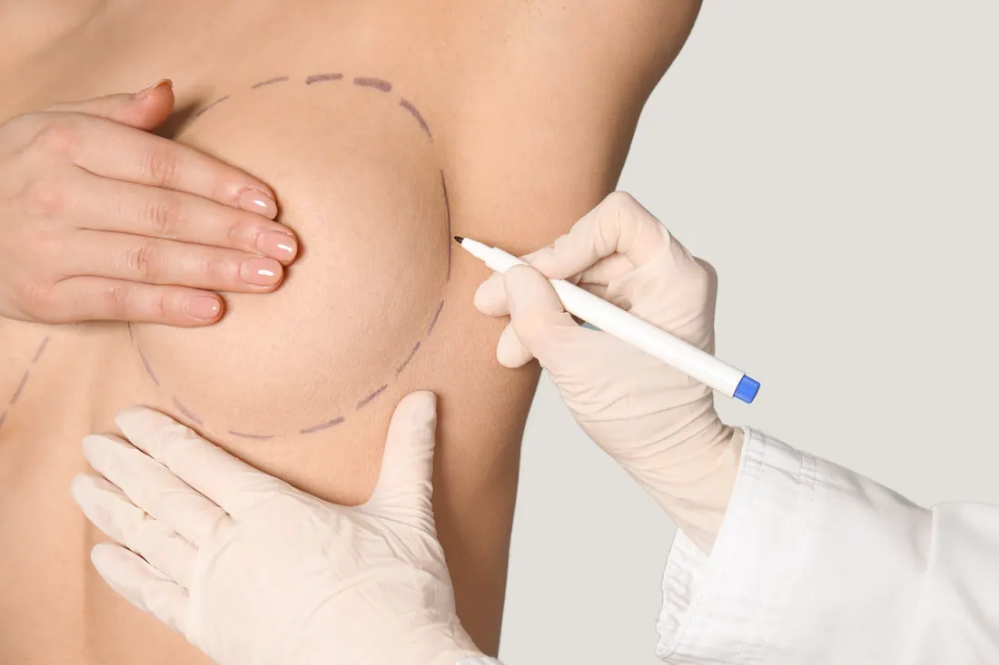 Mamoplastia Redutora e de Aumento