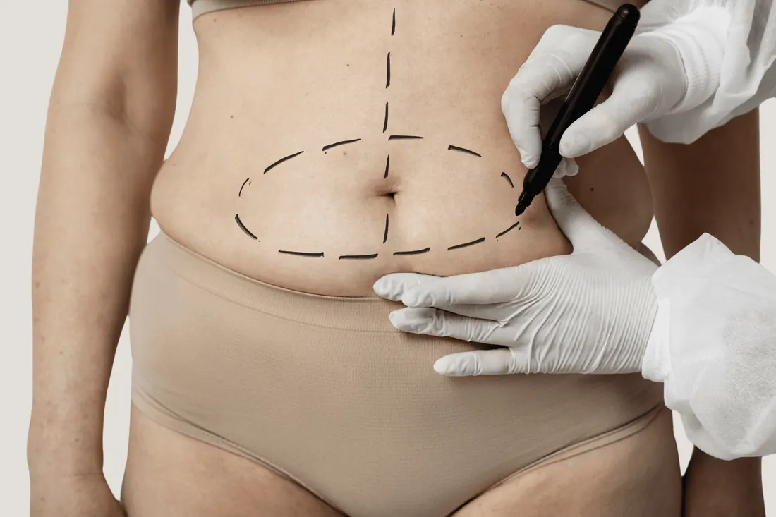 Cirurgia Pós-Emagrecimento