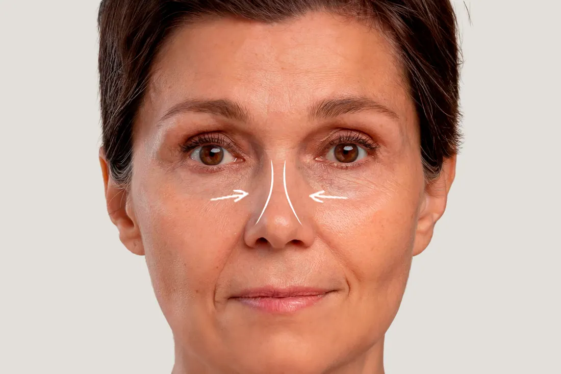 Rinoplastia